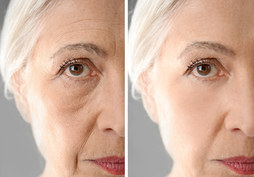 Before and after Sculptra treatment showing facial rejuvenation at Elite Med Spa