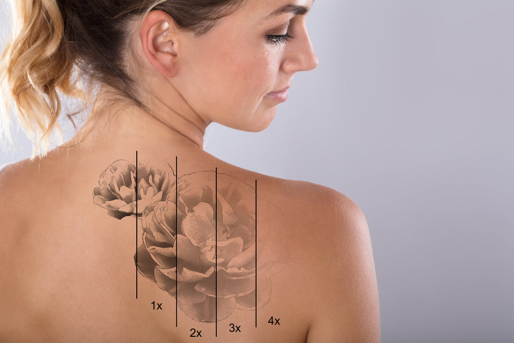 Tattoo fading progression during PicoSure Pro laser removal at Elite Med Spa