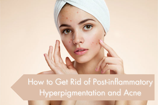 How to Get Rid of Post-inflammatory Hyperpigmentation and Acne