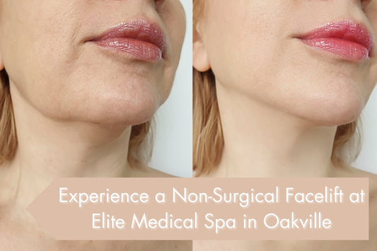 Experience a Non-Surgical Facelift at Elite Medical Spa in Oakville