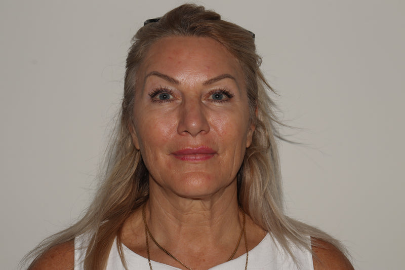 XERF Skin Tightening before