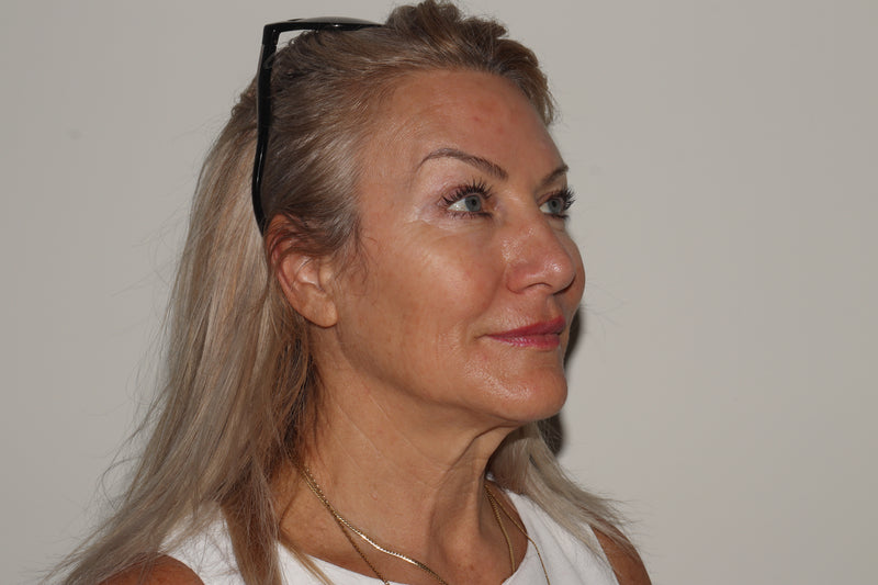 XERF Skin Tightening before