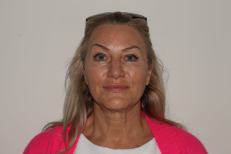 XERF Skin Tightening after