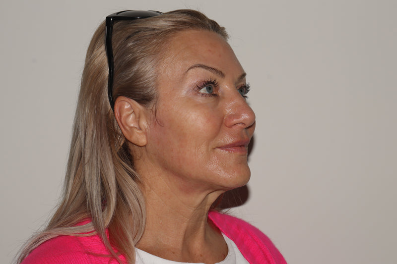XERF Skin Tightening after