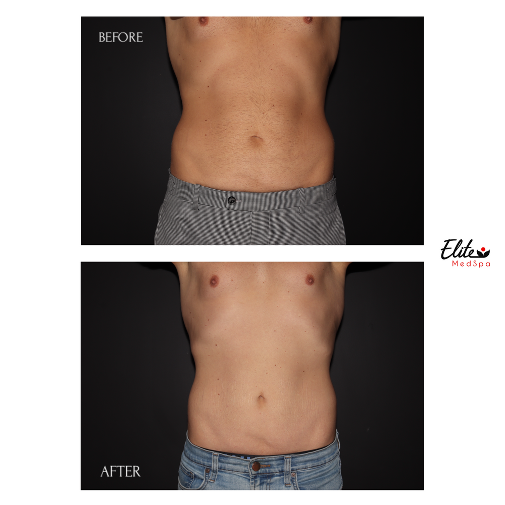 Potenza RF Microneedling before and after at Elite Med Spa