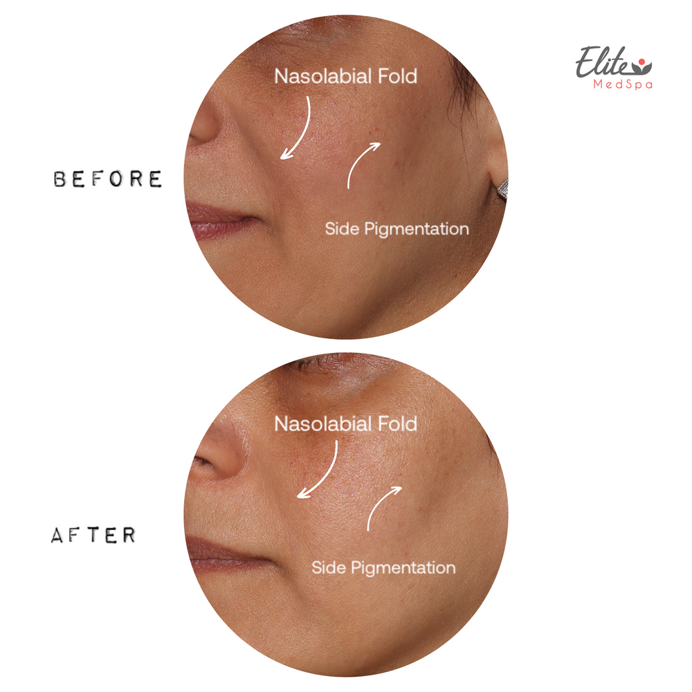 PicoSure Pro before and after at Elite Med Spa