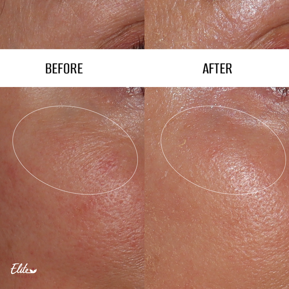 TempSure RF before and after at Elite Med Spa