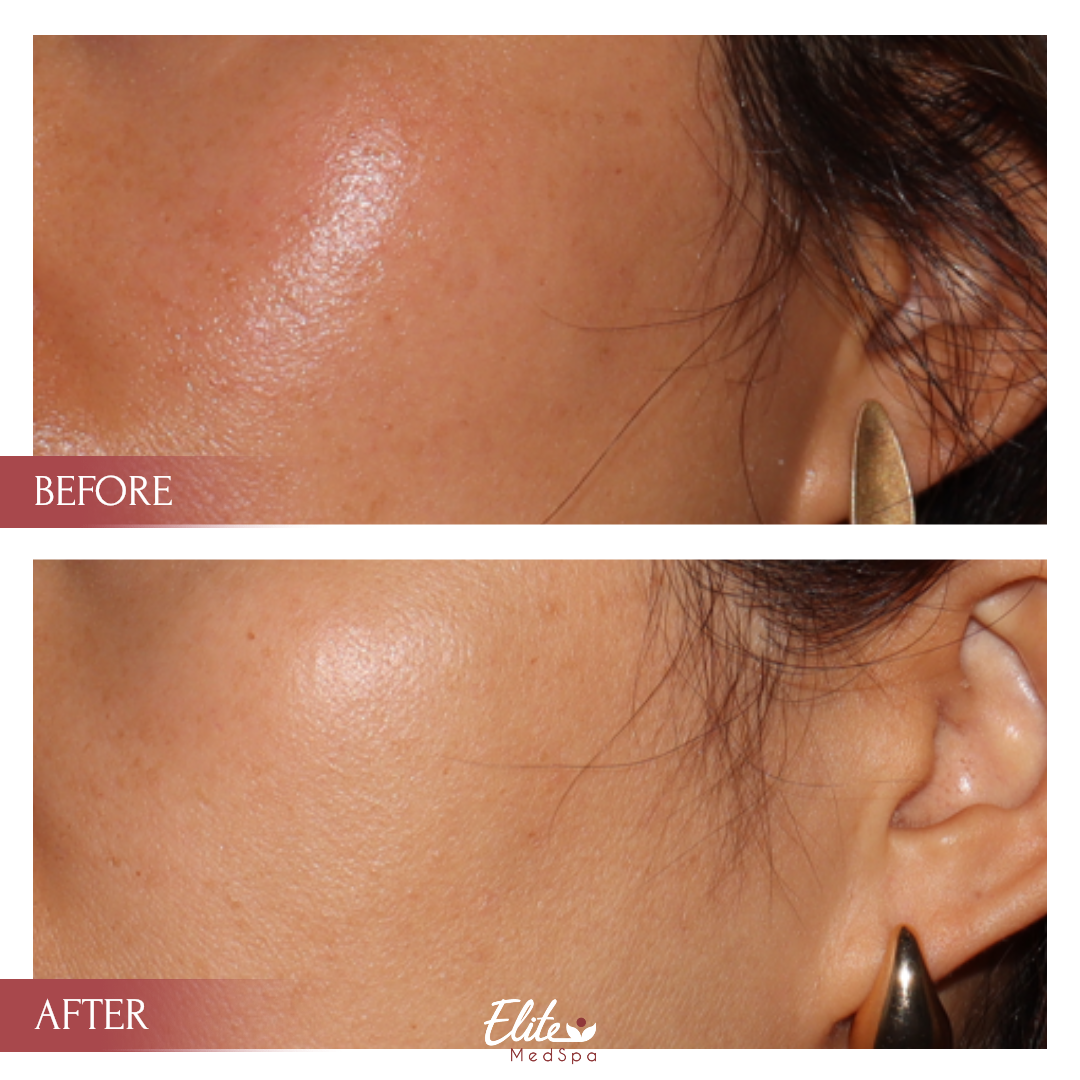 Before and after PicoSure Pro skin treatment at Elite Med Spa Toronto, showing improved skin tone and reduced pigmentation around the temple area.
