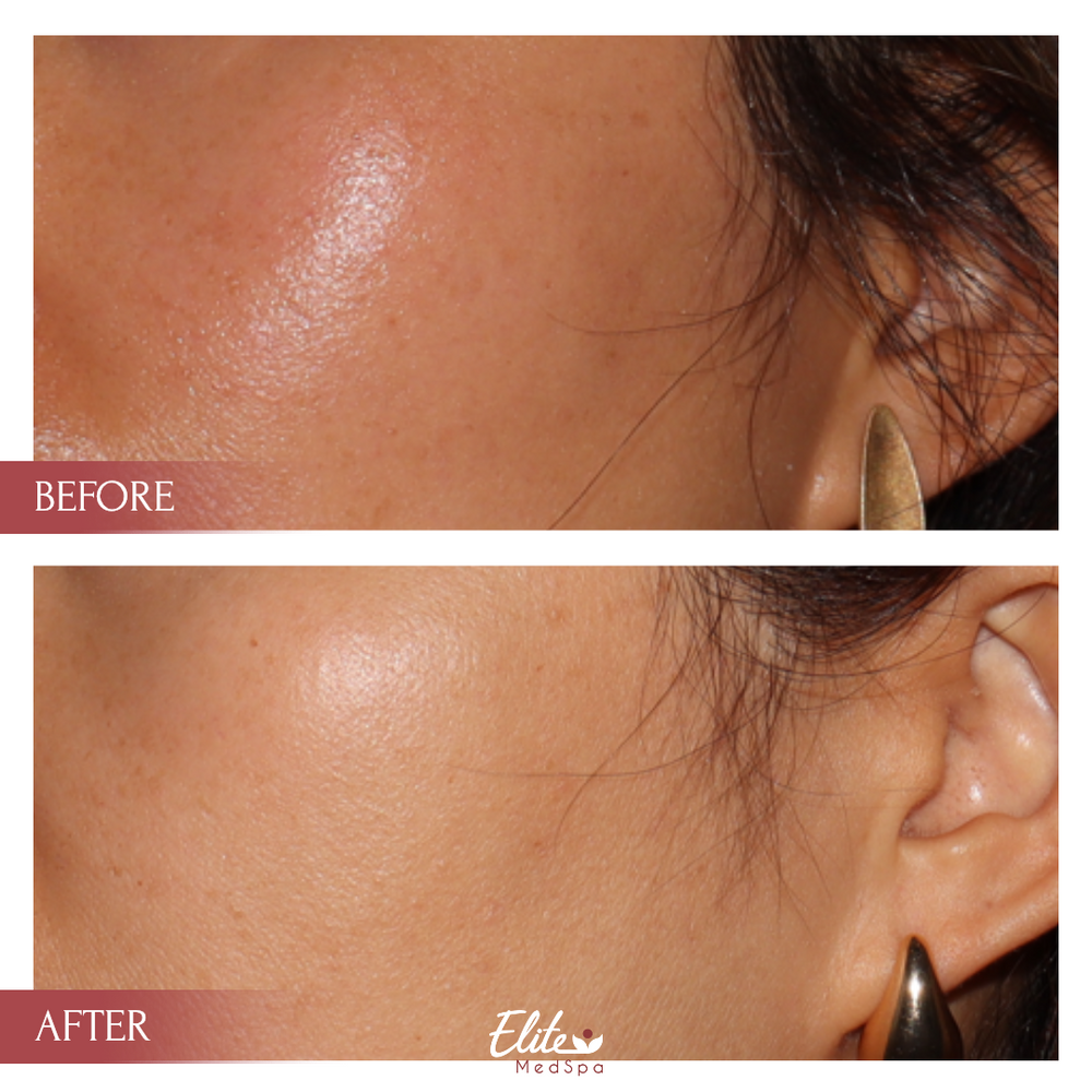 PicoSure Pro before and after at Elite Med Spa
