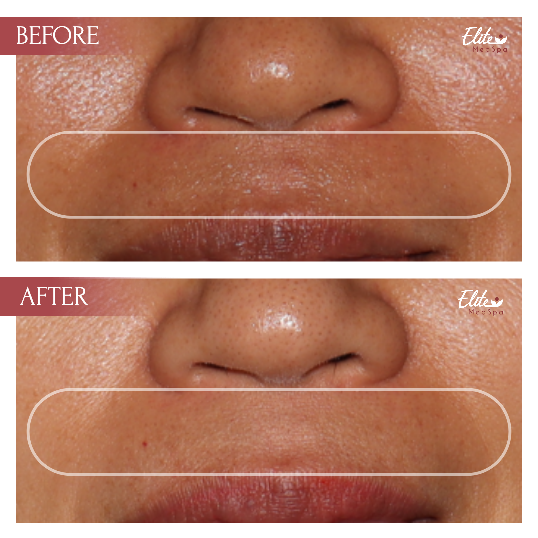 Before and after PicoSure Pro skin treatment at Elite Med Spa Toronto, showing improved skin tone and reduced pigmentation around the temple area.